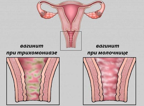Зуд половых органов у женщин