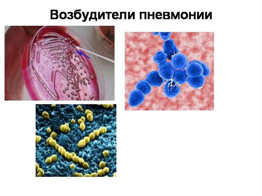 Возбудители внебольничной пневмонии. Возбудитель крупозной пневмонии. Пневмония возбудитель болезни. Пневмония возбудитель бактерия.